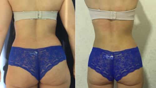 Liposuction Colombia - Premium Care Plastic Surgery