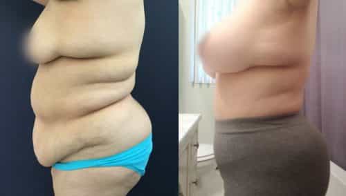 Liposuction Colombia - Premium Care Plastic Surgery