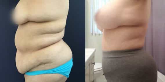 Liposuction Colombia - Premium Care Plastic Surgery
