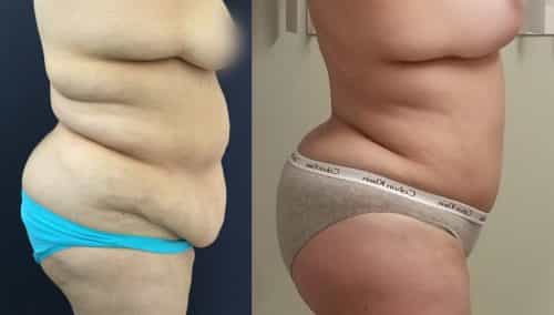 Liposuction Colombia - Premium Care Plastic Surgery