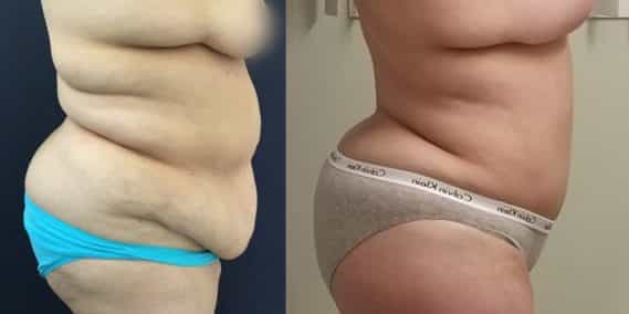 Liposuction Colombia - Premium Care Plastic Surgery