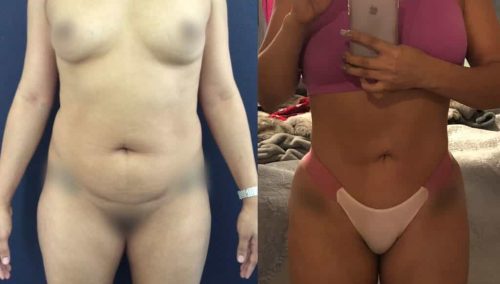 Liposuction Colombia - Premium Care Plastic Surgery
