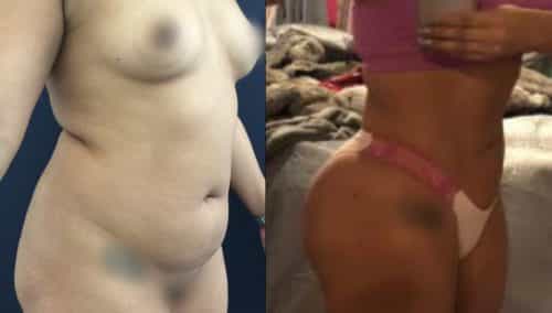 Liposuction Colombia - Premium Care Plastic Surgery