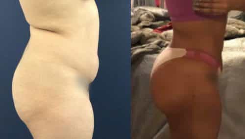 Liposuction Colombia - Premium Care Plastic Surgery