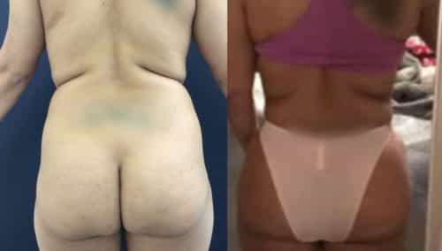 Liposuction Colombia - Premium Care Plastic Surgery