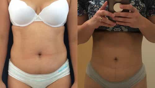Liposuction Colombia - Premium Care Plastic Surgery
