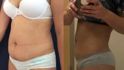 Liposuction Colombia - Premium Care Plastic Surgery