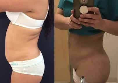 Liposuction Colombia - Premium Care Plastic Surgery