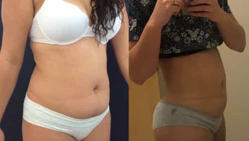 Liposuction Colombia - Premium Care Plastic Surgery