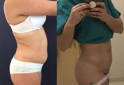 Liposuction Colombia - Premium Care Plastic Surgery