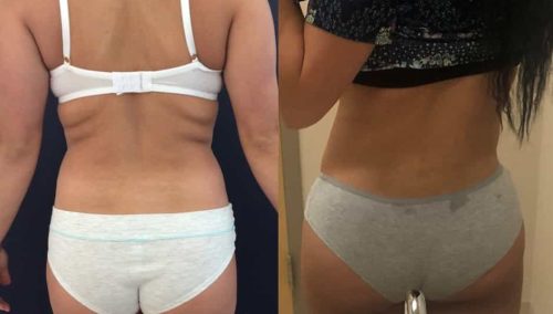 Liposuction Colombia - Premium Care Plastic Surgery