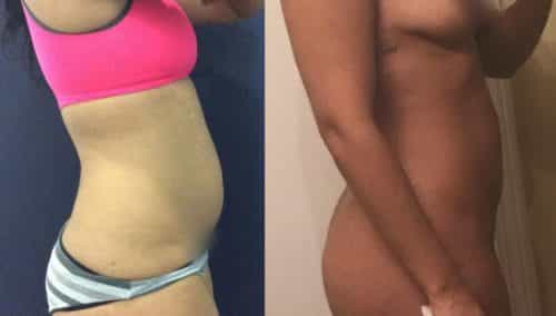 Liposuction Colombia - Premium Care Plastic Surgery