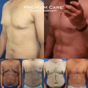 Male Breast Reduction Colombia - Premium Care Plastic Surgery