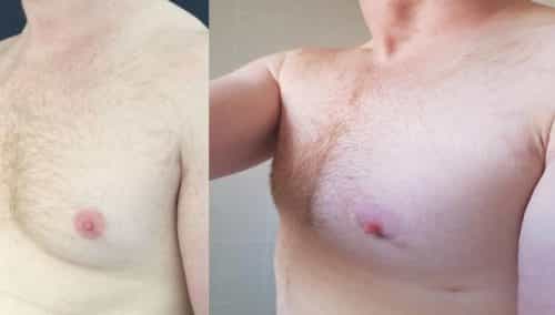 Before and After Male Breast Reduction Colombia - Premium Care Plastic Surgery