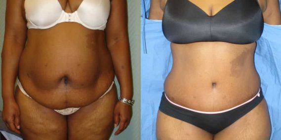 Before and after Mommy Makeover Colombia - Premium Care Plastic Surgery