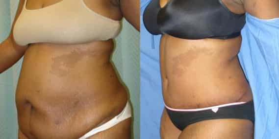 Before and after Mommy Makeover Colombia - Premium Care Plastic Surgery