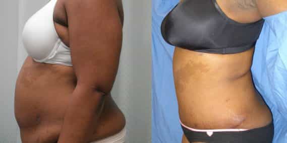 Before and after Mommy Makeover Colombia - Premium Care Plastic Surgery