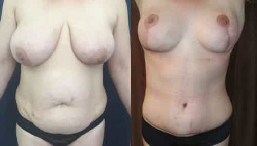 Before and after Mommy Makeover Colombia - Premium Care Plastic Surgery