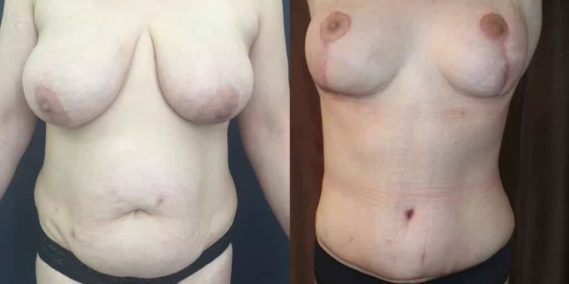 Before and after Mommy Makeover Colombia - Premium Care Plastic Surgery