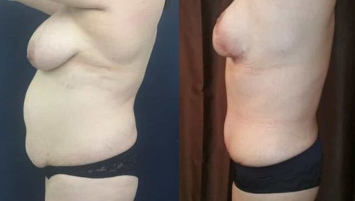 Before and after Mommy Makeover Colombia - Premium Care Plastic Surgery