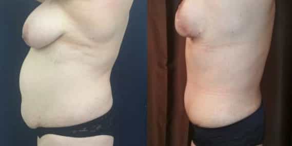 Before and after Mommy Makeover Colombia - Premium Care Plastic Surgery