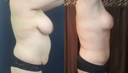 Before and after Mommy Makeover Colombia - Premium Care Plastic Surgery