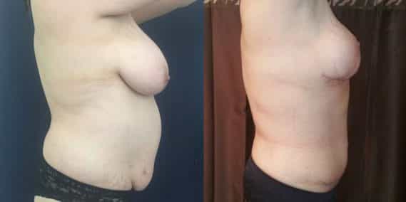Before and after Mommy Makeover Colombia - Premium Care Plastic Surgery