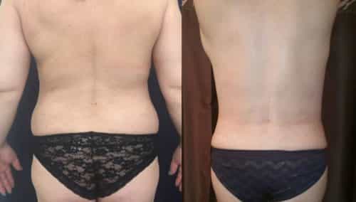 Before and after Mommy Makeover Colombia - Premium Care Plastic Surgery