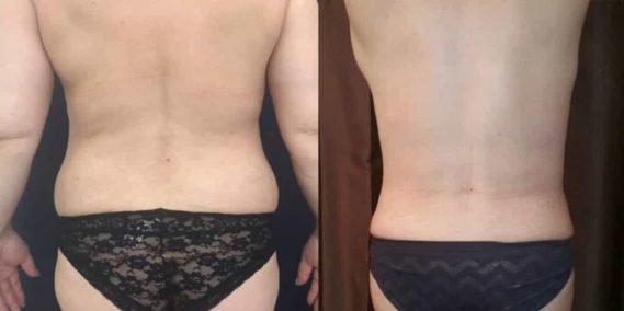 Before and after Mommy Makeover Colombia - Premium Care Plastic Surgery