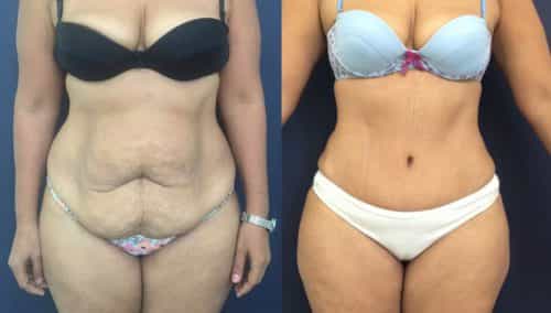 Before and after Mommy Makeover Colombia - Premium Care Plastic Surgery