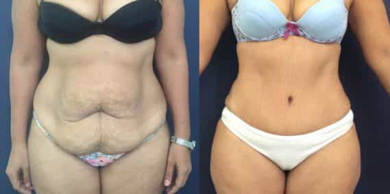 Before and after Mommy Makeover Colombia - Premium Care Plastic Surgery