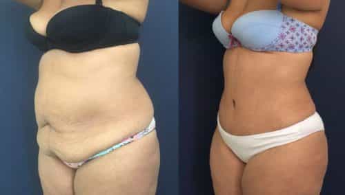 Before and after Mommy Makeover Colombia - Premium Care Plastic Surgery