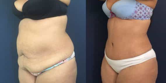 Before and after Mommy Makeover Colombia - Premium Care Plastic Surgery