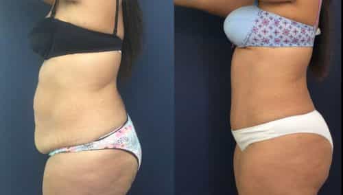 Before and after Mommy Makeover Colombia - Premium Care Plastic Surgery