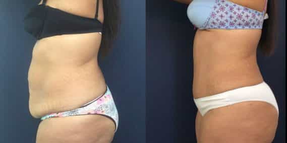 Before and after Mommy Makeover Colombia - Premium Care Plastic Surgery