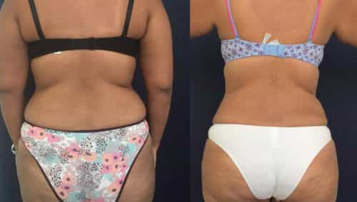 Before and after Mommy Makeover Colombia - Premium Care Plastic Surgery