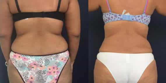 Before and after Mommy Makeover Colombia - Premium Care Plastic Surgery