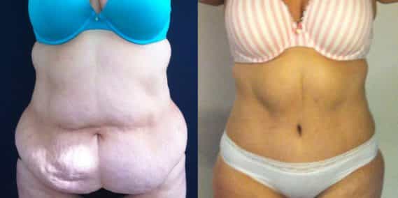 Before and after Mommy Makeover Colombia - Premium Care Plastic Surgery