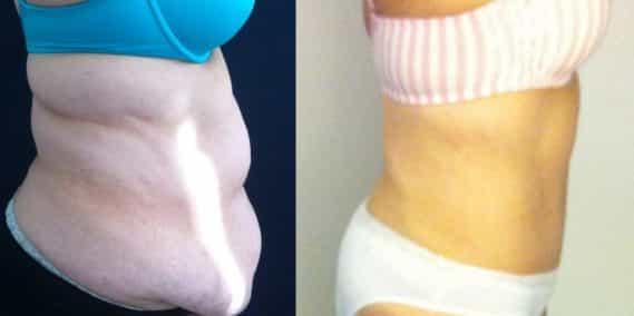 Before and after Mommy Makeover Colombia - Premium Care Plastic Surgery