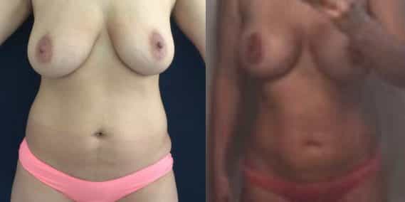 Before and after Mommy Makeover Colombia - Premium Care Plastic Surgery