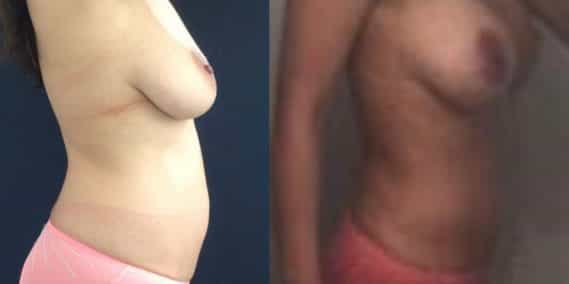 Before and after Mommy Makeover Colombia - Premium Care Plastic Surgery