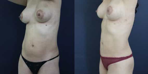 Before and after Mommy Makeover Colombia - Premium Care Plastic Surgery