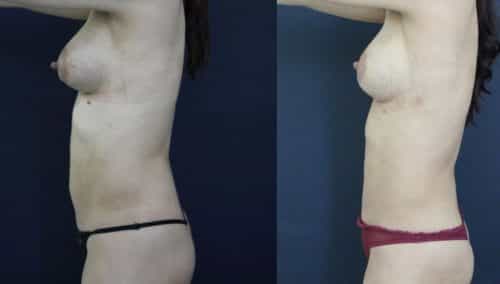 Before and after Mommy Makeover Colombia - Premium Care Plastic Surgery