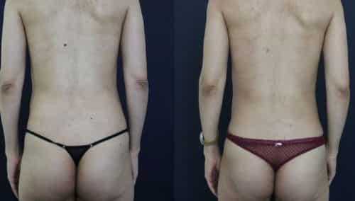 Before and after Mommy Makeover Colombia - Premium Care Plastic Surgery
