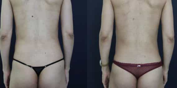Before and after Mommy Makeover Colombia - Premium Care Plastic Surgery