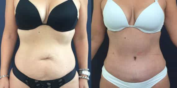 Before and after Mommy Makeover Colombia - Premium Care Plastic Surgery