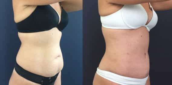Before and after Mommy Makeover Colombia - Premium Care Plastic SurgeryMommy Makeover Cartagena Colombia - Premium Care Plastic Surgery