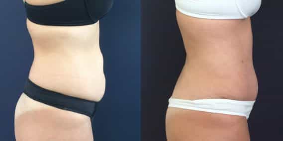 Before and after Mommy Makeover Colombia - Premium Care Plastic Surgery