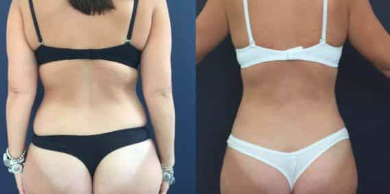 Before and after Mommy Makeover Colombia - Premium Care Plastic Surgery