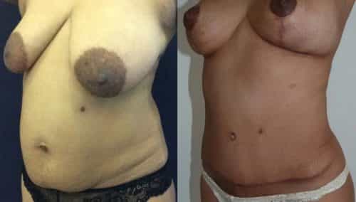 Before and after Mommy Makeover Colombia - Premium Care Plastic Surgery